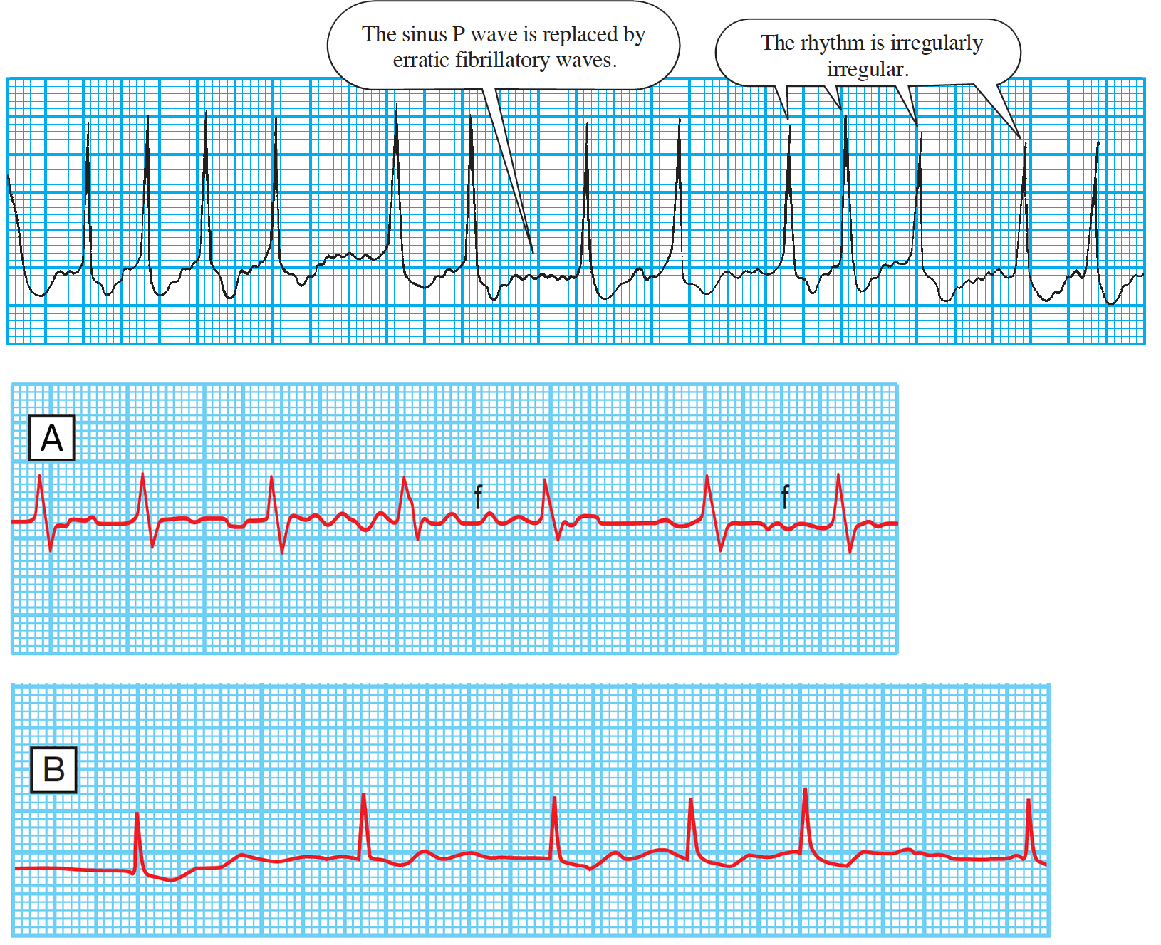 Atrial Fibrillation - Rimikri Med