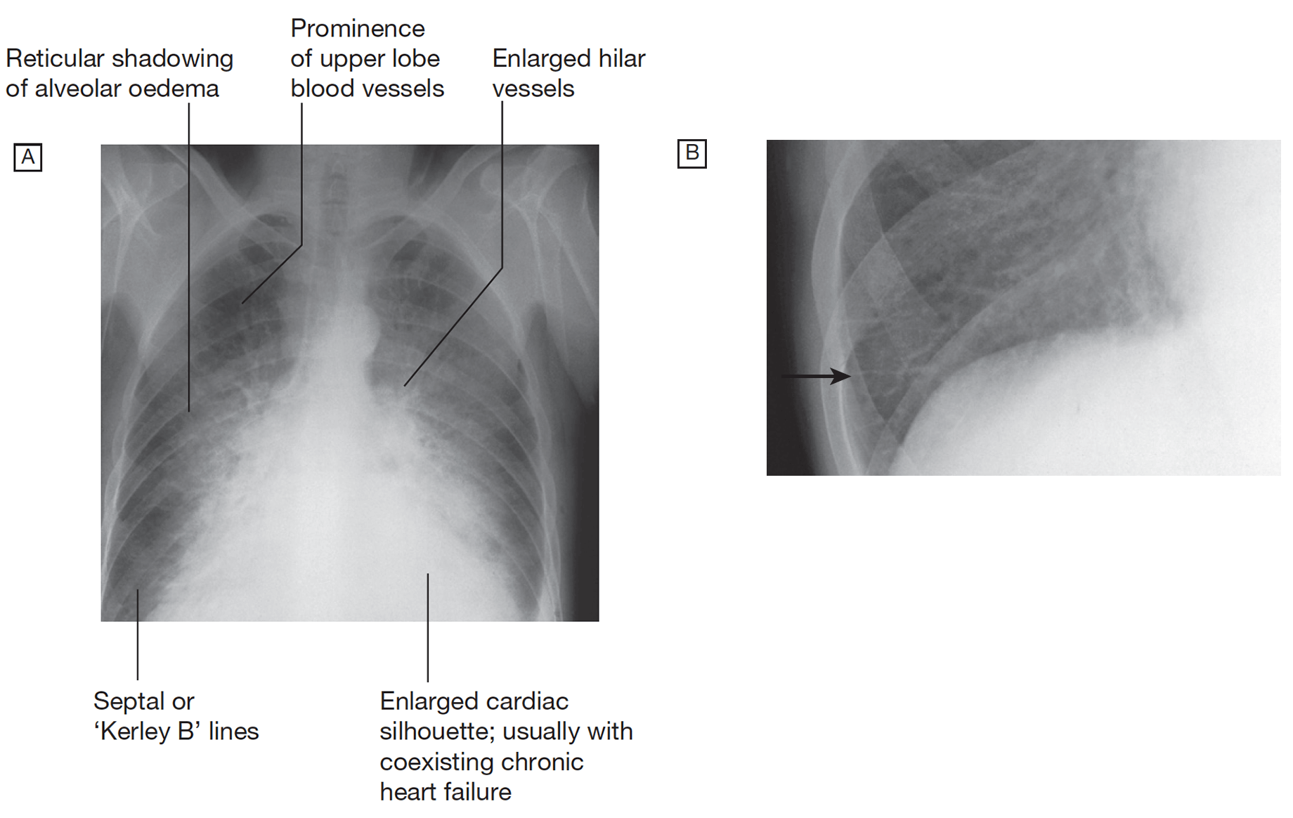 Congestive Cardiac Failure (CCF) - Rimikri Med